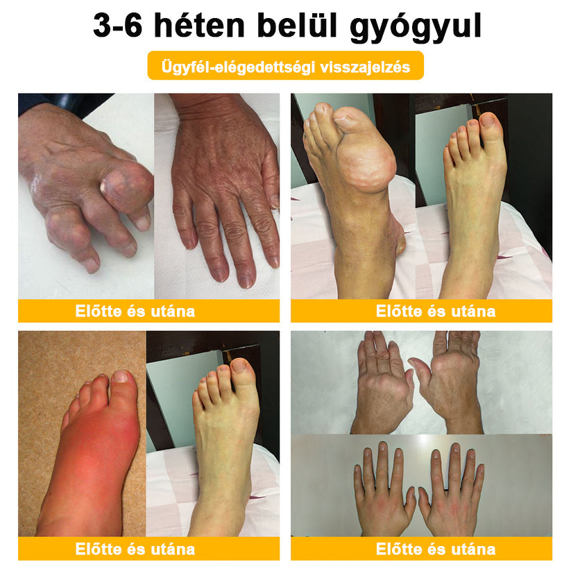 💧🐝ADNOON® Botulinum Toxin & Méhméreg Fájdalomcsillapító Csontgyógyító Krém👨⚕️A Magyar Ortopéd Társaság (MOT) Által Jóváhagyva
